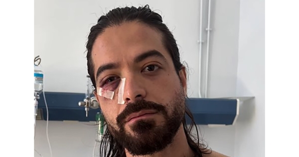 Άρης Μουγκοπέτρος: Τα πρώτα λόγια του για την κροτίδα και την έκρηξη - «Νόμιζα ότι ήταν καπνογόνο»