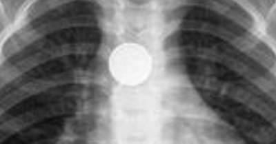 Τέλος καλό για το τρίχρονο που κατάπιε ξυραφάκι - Από καπάκια μέχρι παραμάνες «δοκιμάζουν» τα παιδιά