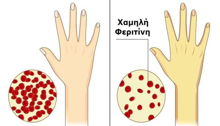 Κούραση, αδυναμία, θολούρα: Τα σημάδια χαμηλής φεριτίνης που δεν πρέπει να αγνοείς